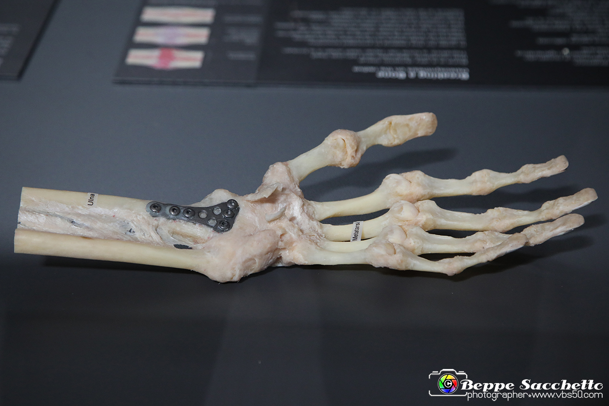 VBS_3149 - Ossa rotte. Osteosintesi del radio - Mostra Body Worlds.jpg